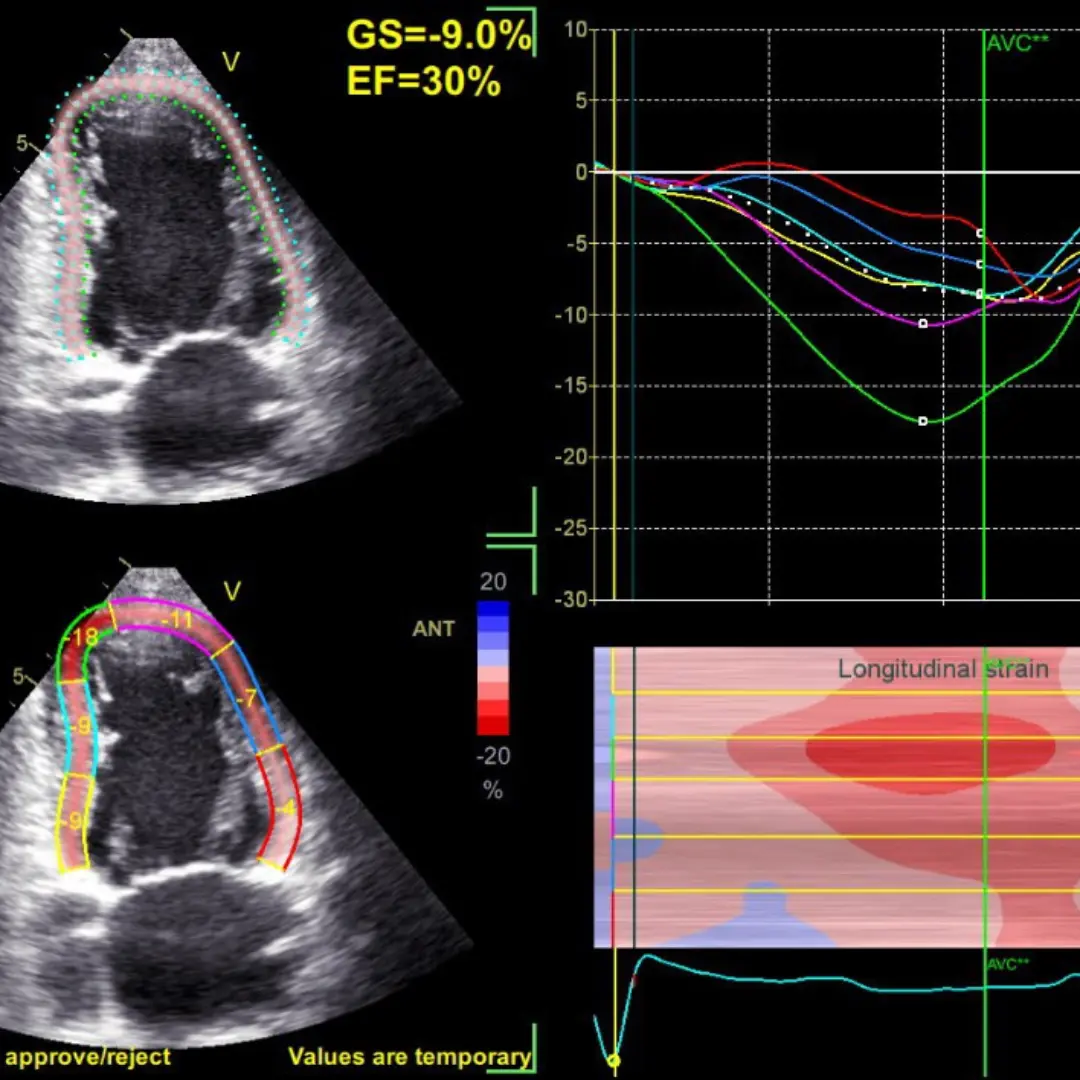 Стрейн ЕхоКГ (спрекл-трекінг)