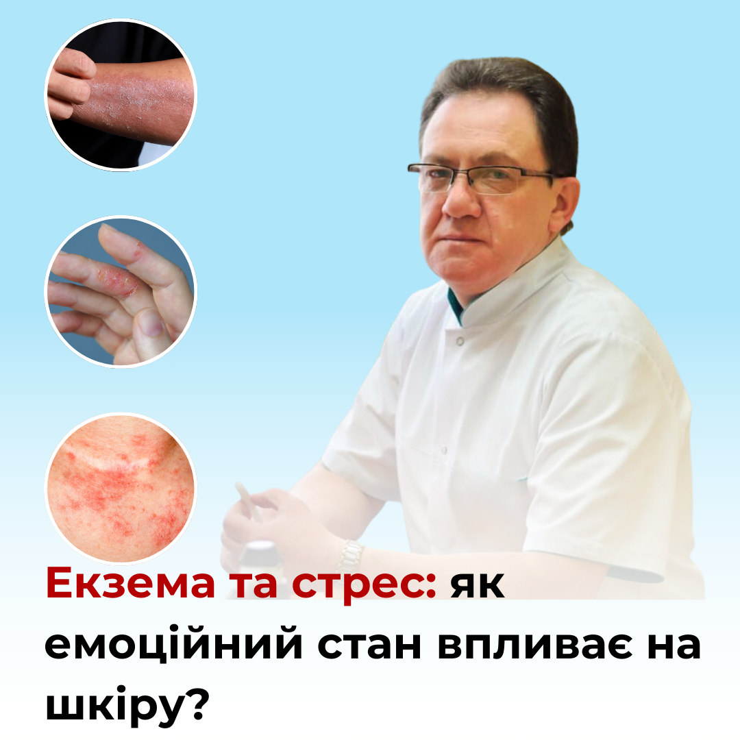 екзема та стрес